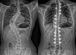 Scoliose : causes et symptômes