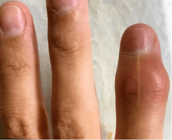Rhumatisme psoriasique : symptômes, causes et traitements