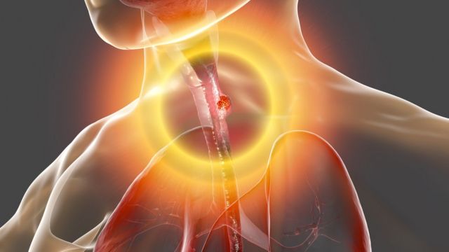 Les cancers de l'œsophage : causes, symptômes et traitement