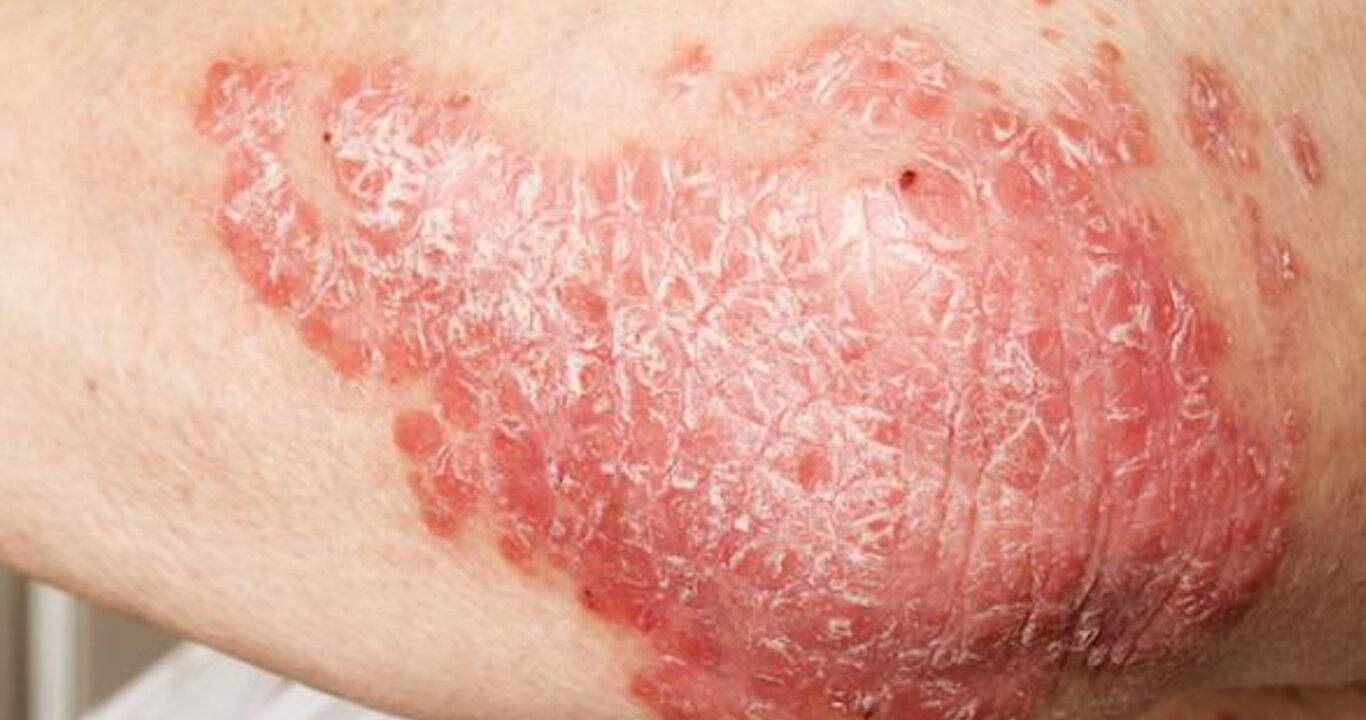 Eczéma : causes, symptômes et traitements