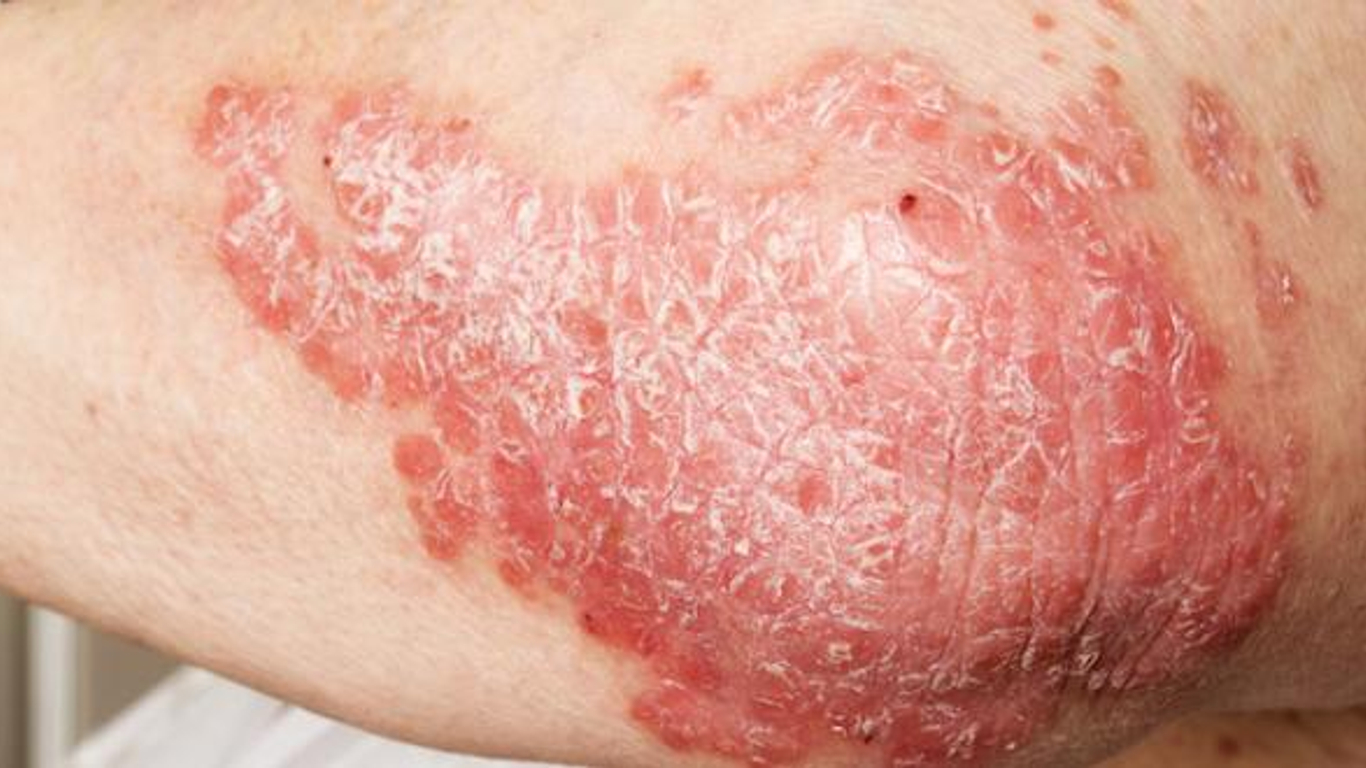 Eczéma : causes, symptômes et traitements