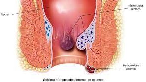 Hémorroïdes : symptômes, causes et traitements