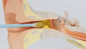 L'oreille qui gratte : d'où viennent les démangeaisons des oreilles ?