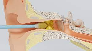 L'oreille qui gratte : d'où viennent les démangeaisons des oreilles ?