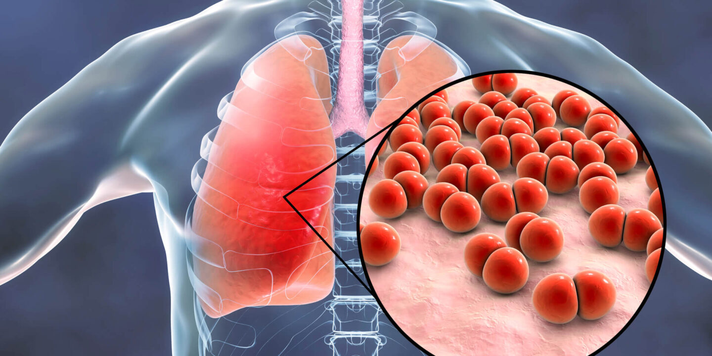 Pneumonie bactérienne, on en parle.