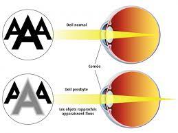 Presbytie : symptômes, causes et traitements