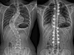 Scoliose : causes et symptômes